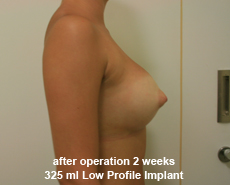 plastic-surgery-breast-augmentation